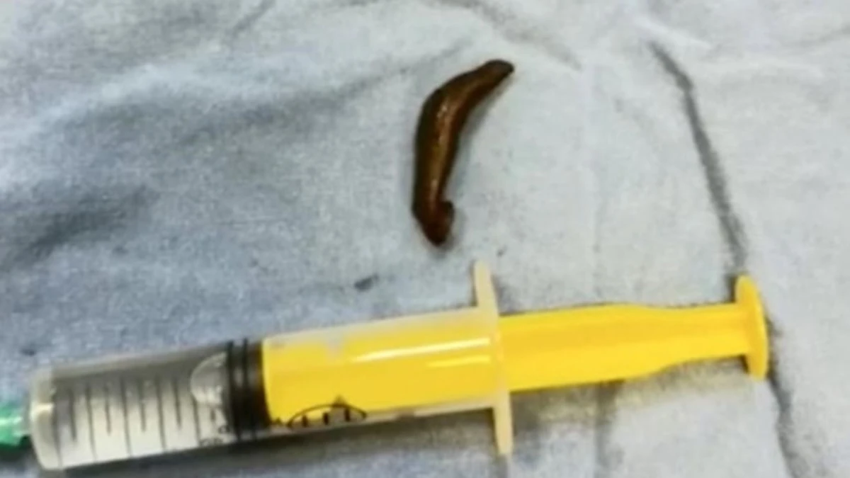 Çorum’da boğaz ağrısının nedeni canlı sülük çıktı